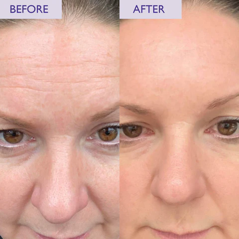 SKINICIAN Retinol Before and After 480x480 1