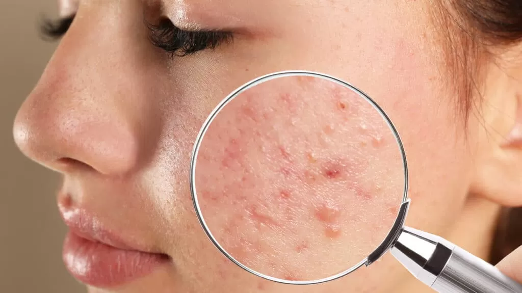 چگونه جوش های صورت را از بین ببریم؟ 1 های درمان جوش صورت