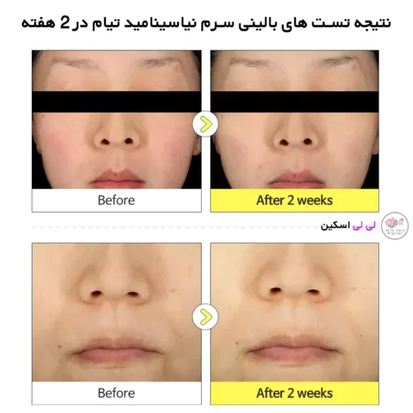 سرم ضد لک نیاسینامید تیام حجم 40 میلی لیتر