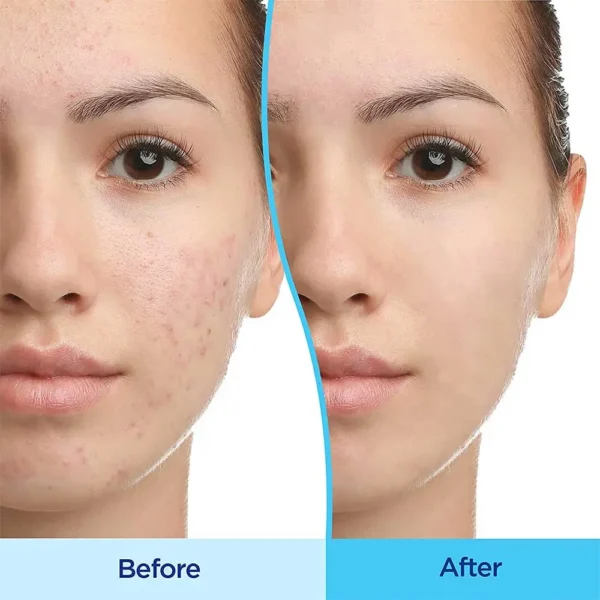 ژل دیفرین حجم 30 میلی لیتر